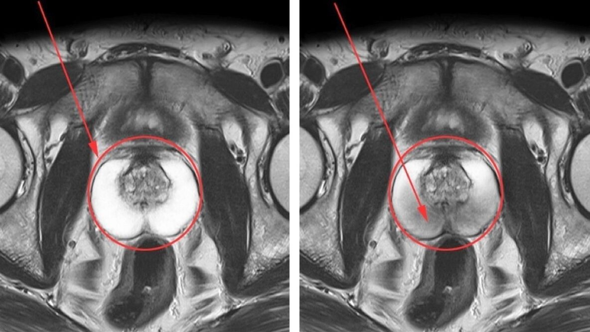 Ultrahang krónikus prosztatagyulladás esetén – egészséges prosztata (balra) és gyulladt (jobbra)