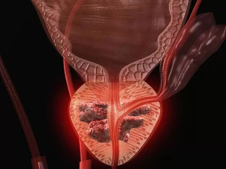 Prostatitis férfiakban