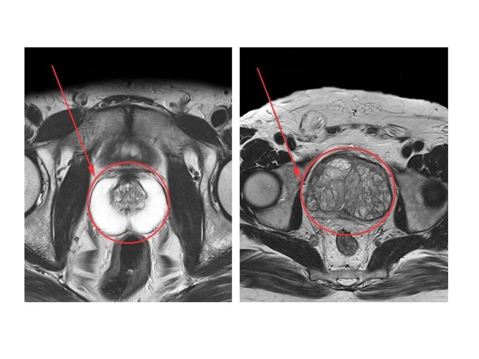 Egészséges (bal oldali) és gyulladt (jobb) prosztata összehasonlítása MRI-felvételeken