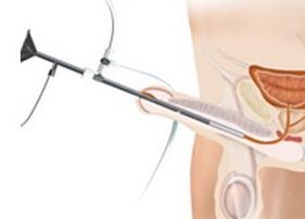 A prosztatagyulladás tünetei - Cikkek Prostatitis és annak kezelése