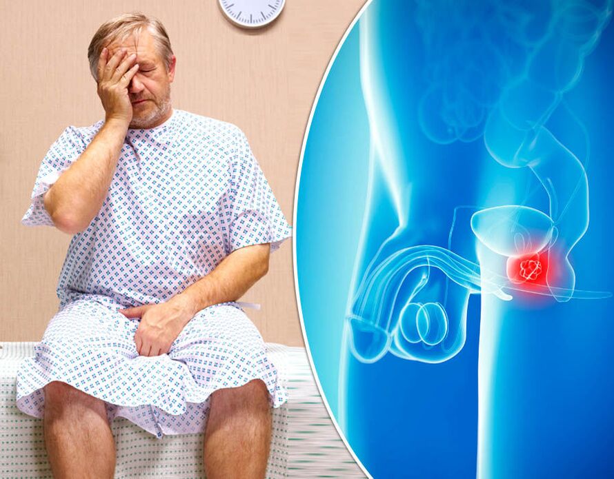 Egy prosztatagyulladásban szenvedő férfinál diagnosztizálják a betegséget